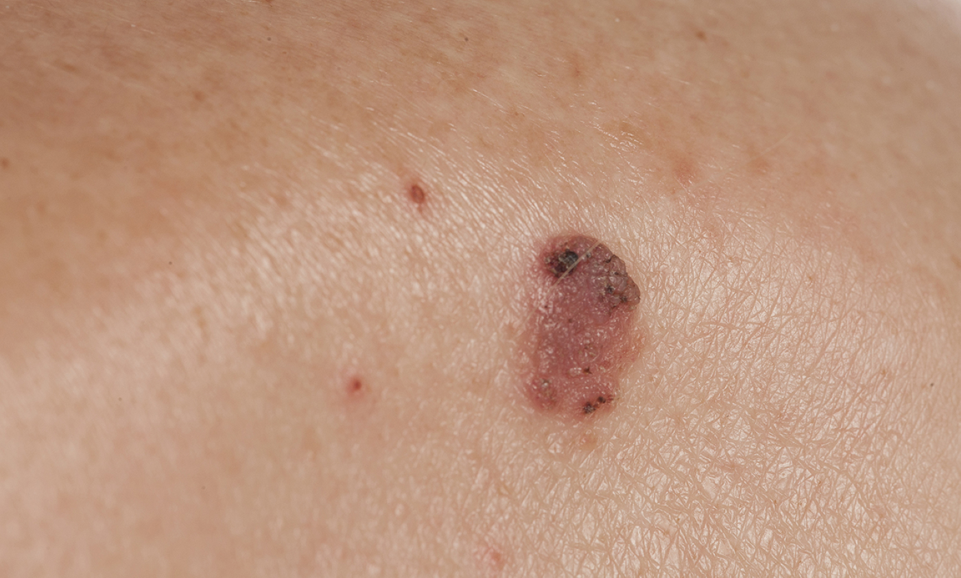 pictures of skin moles cancerous