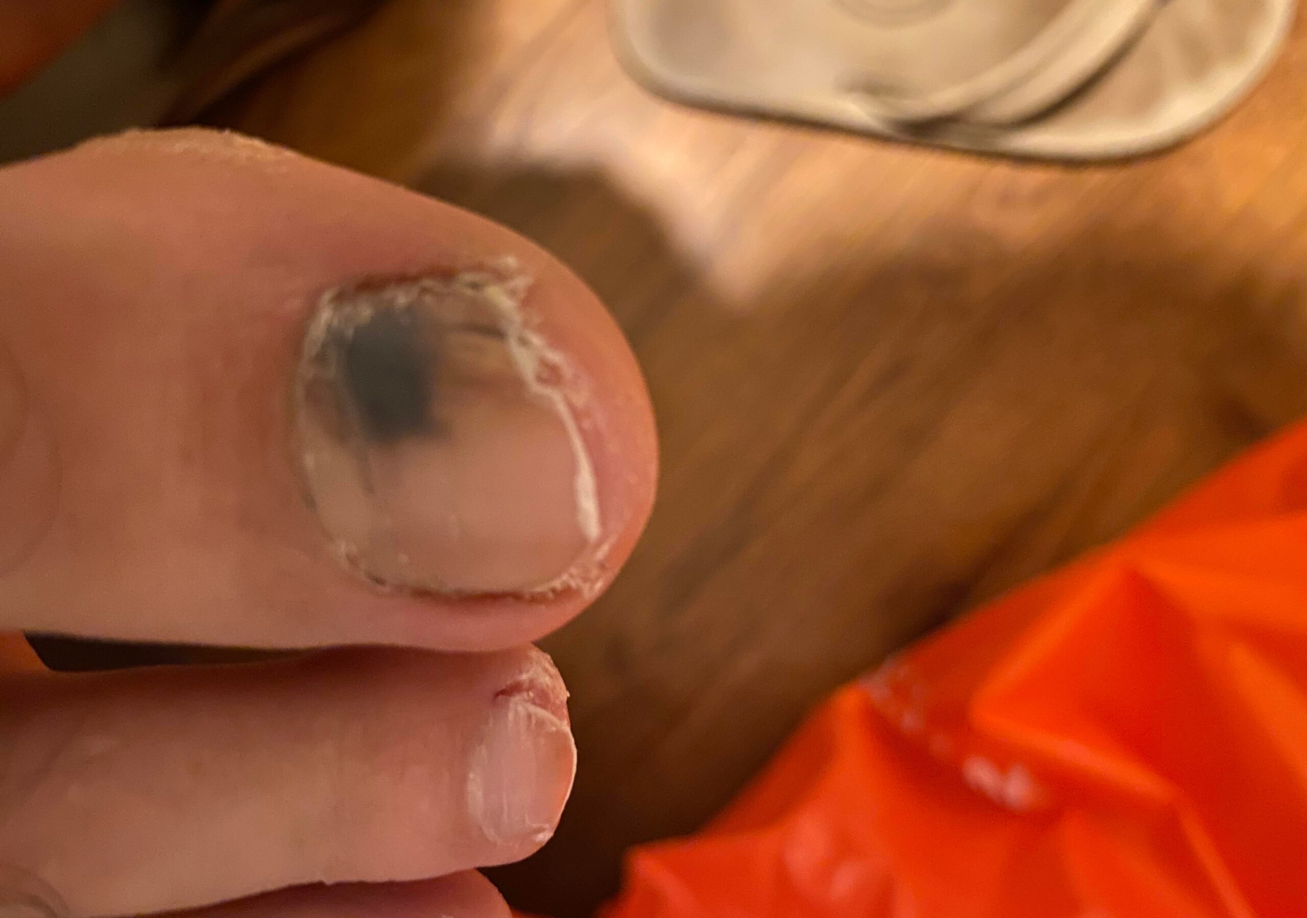 pictures of toenail cancer