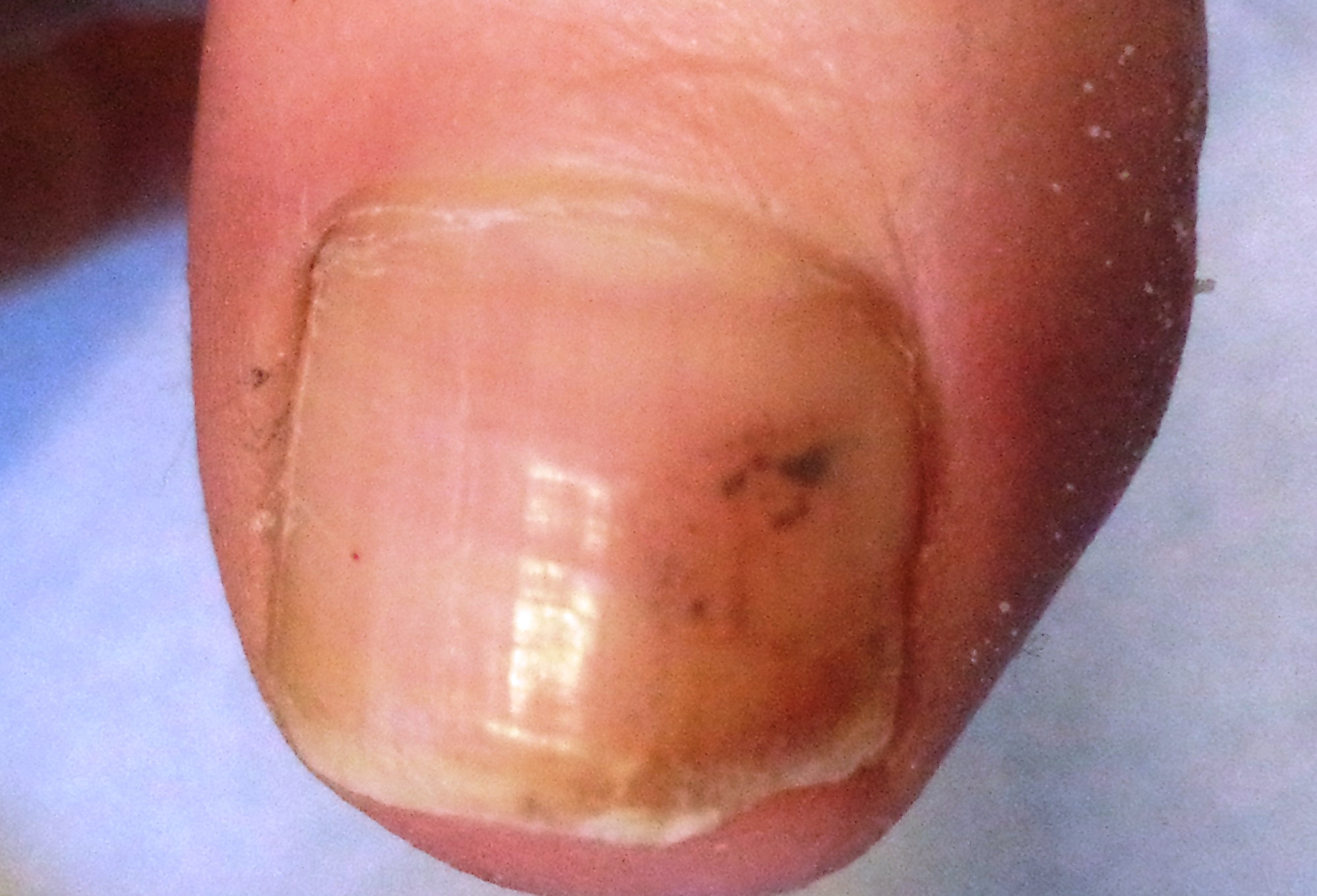 toenail melanoma images