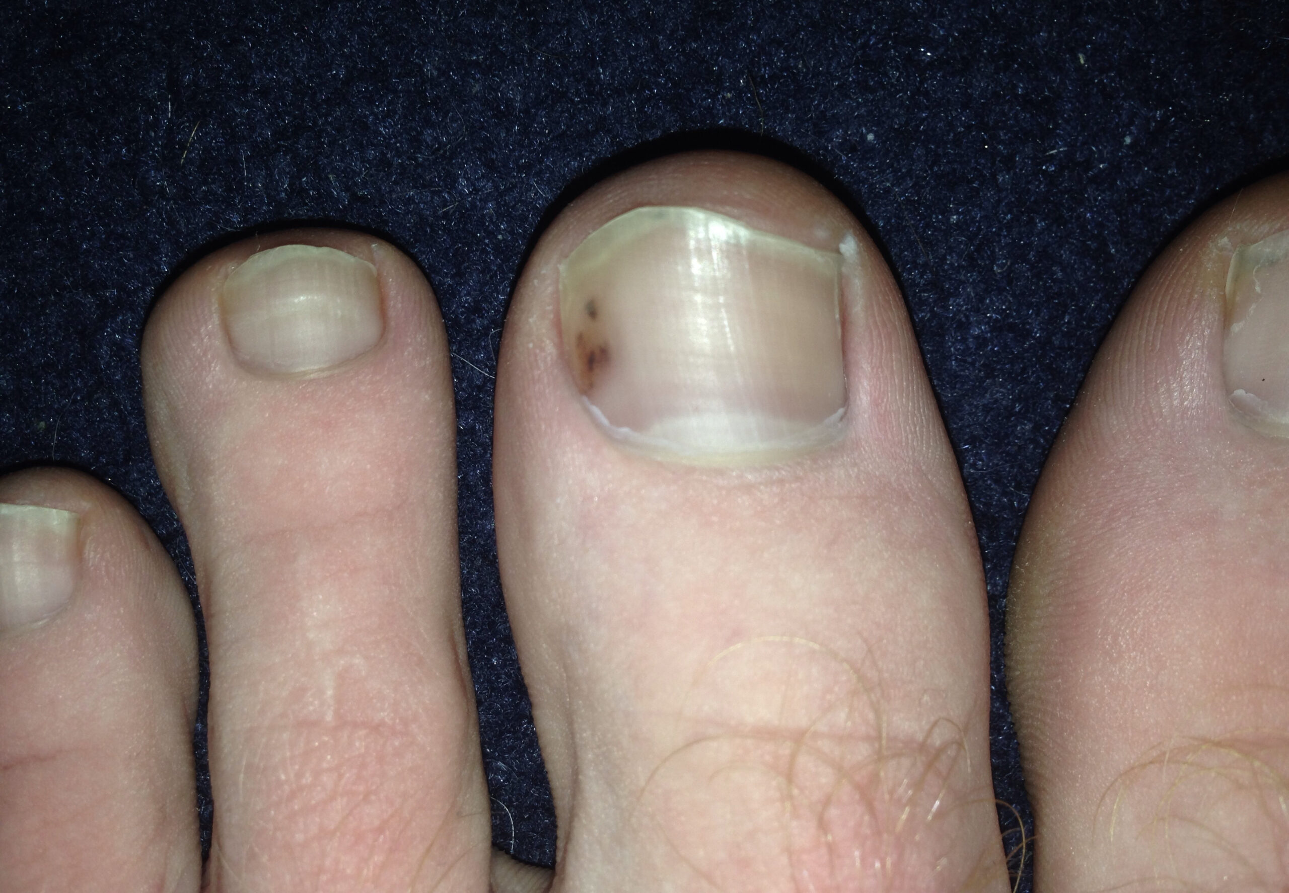 toenail melanoma pictures