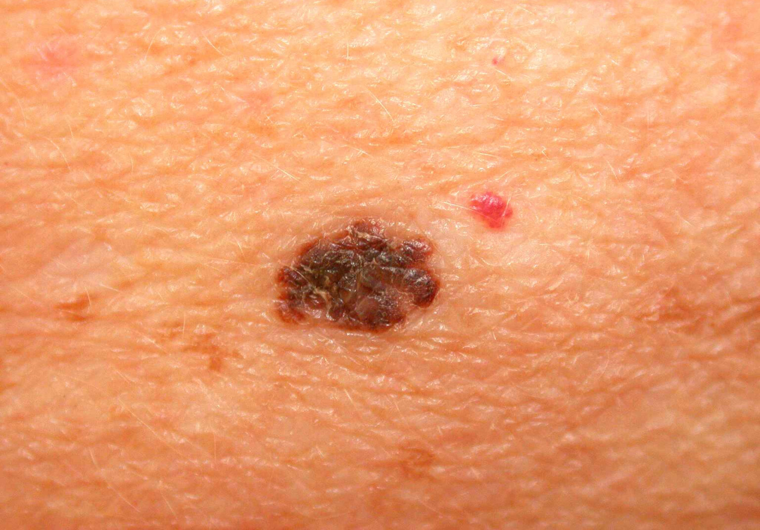 What Cancerous Moles Look Like Symptoms And Pictures