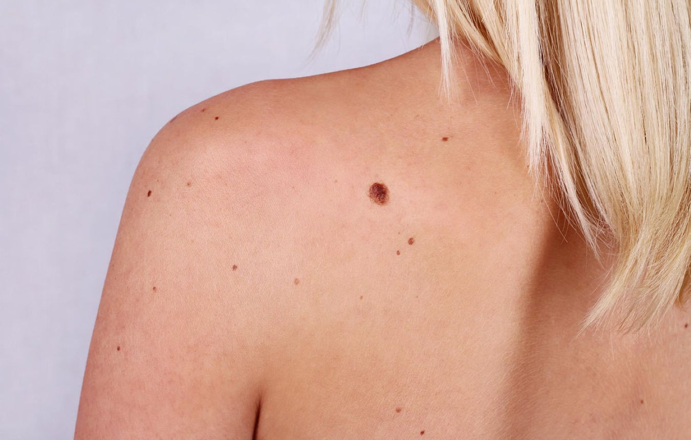 What Does A Cancerous Mole Look Like On The Skin Symptoms And Pictures