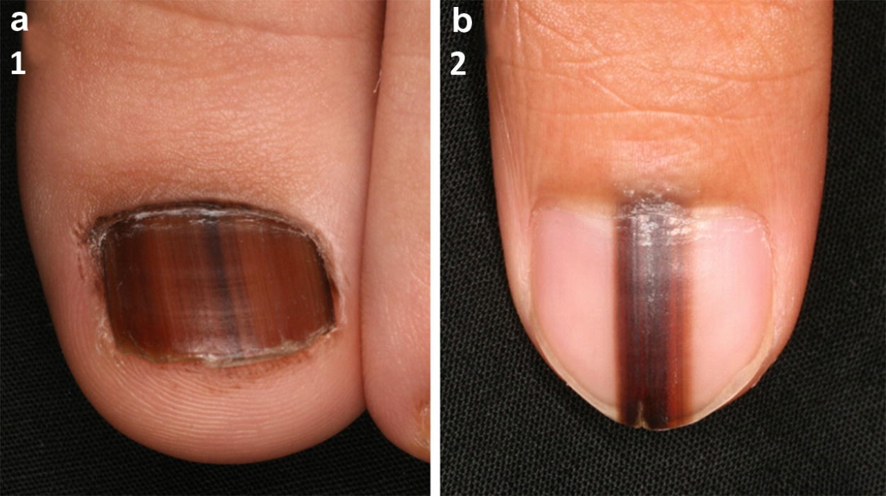 what does melanoma look like under a fingernail