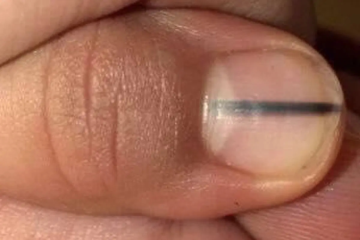 what does melanoma look like under the nail