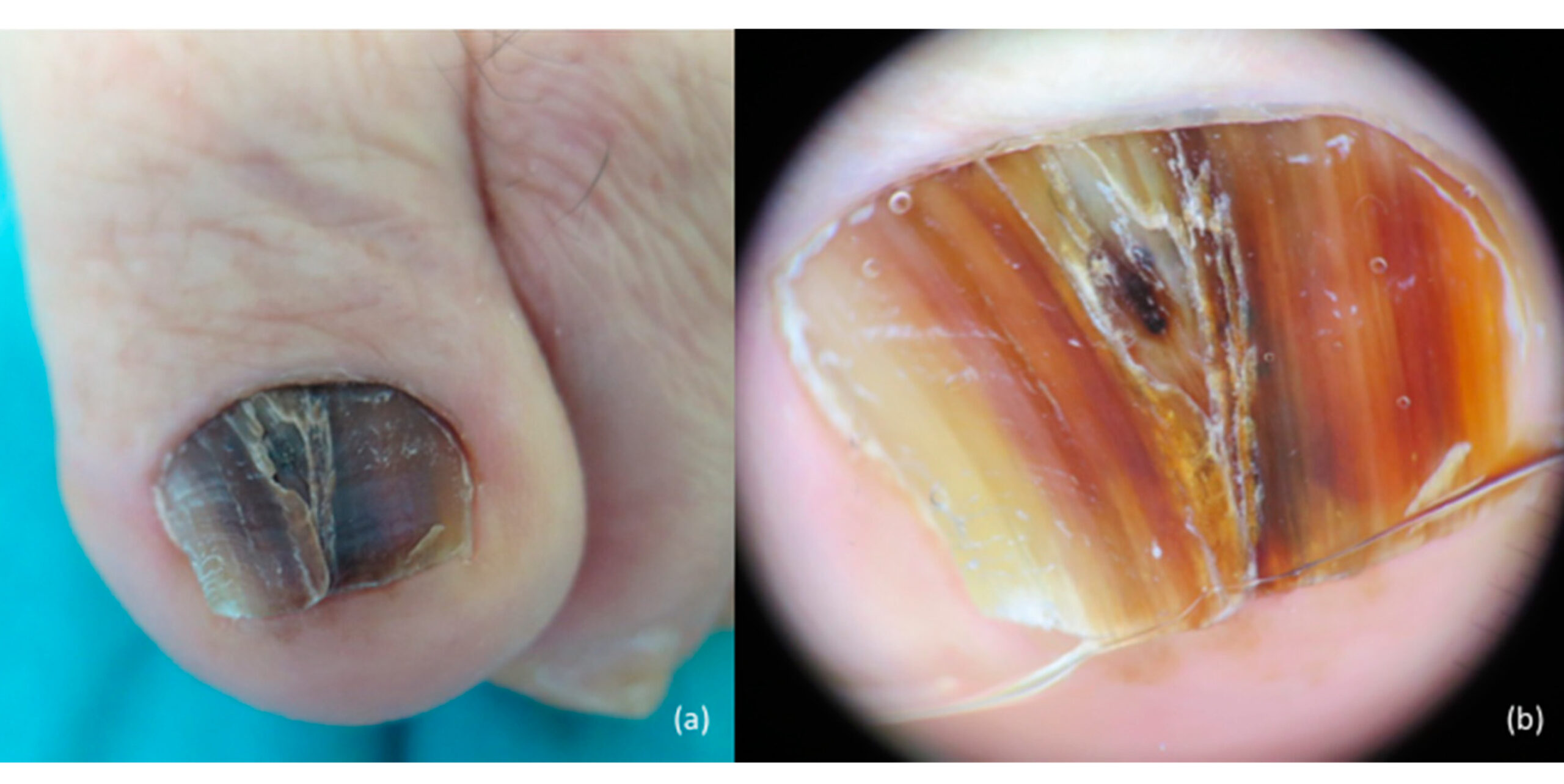 what does melanoma look like under the toenail | Symptoms and pictures