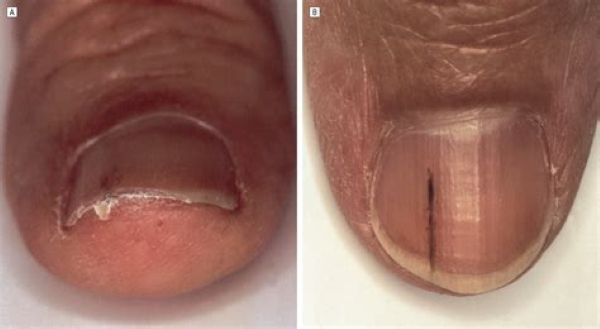 what does melanoma under a toenail look like