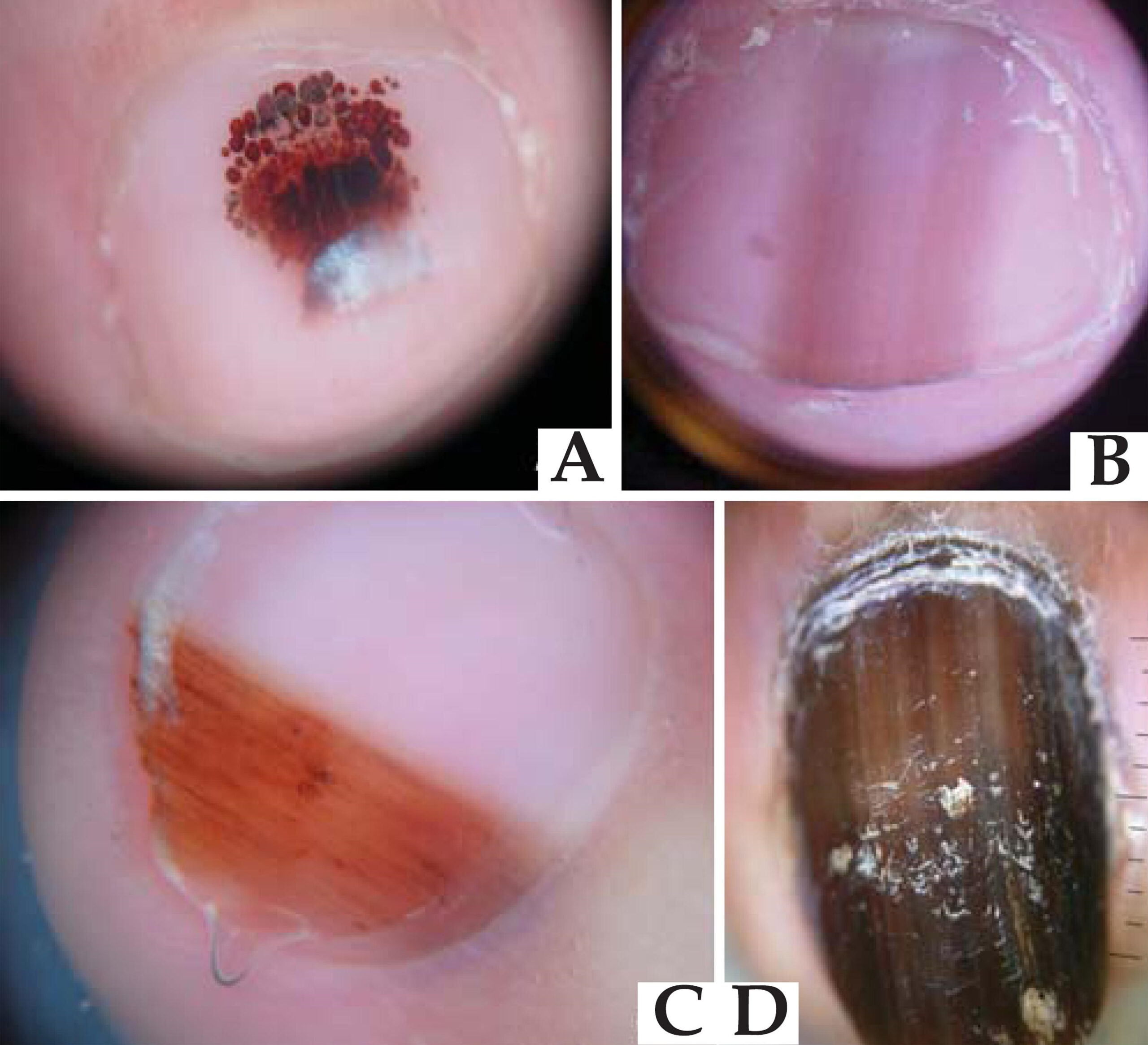 what does toenail melanoma look like