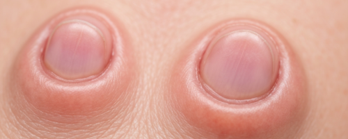 What Does Onychomycosis Look Like Symptoms Pictures