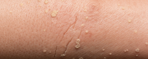 What Does Tinea Pedis Look Like Symptoms Pictures