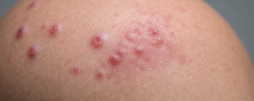 What Does Herpes Zoster Look Like Symptoms Pictures