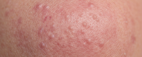 What Does Psoriasis Look Like Symptoms Pictures