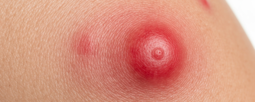 What Does Cherry Angioma Look Like Pictures