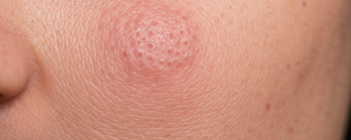 What Does Actinic Keratosis Look Like Pictures