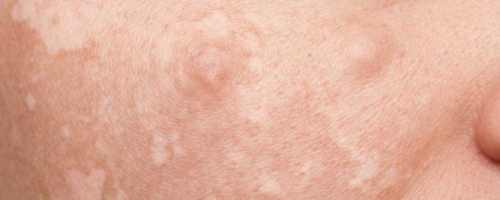 What Does Vitiligo Look Like Symptoms Pictures