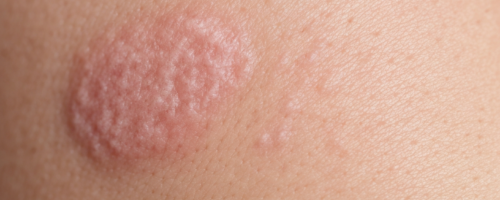 What Does Vaginal Thrush Look Like Symptoms Pictures