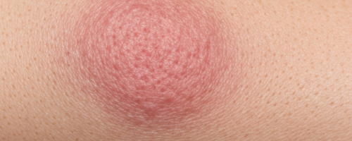 What Does Keloid Look Like Symptoms Pictures