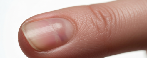 Hygroma of the hand symptoms pictures