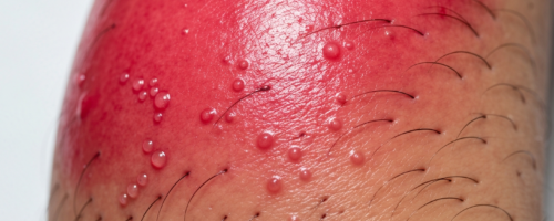 Cellulitis symptoms pictures