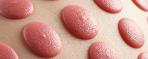 Pityriasis rosea symptoms pictures