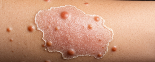 Leprosy symptoms pictures