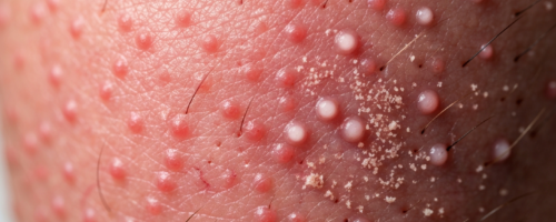 Demodicosis on the face symptoms pictures