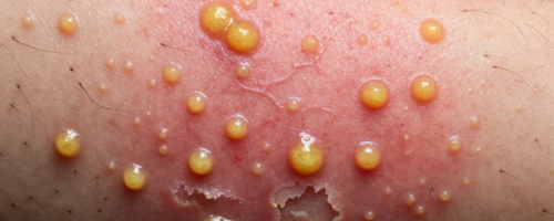 Pyoderma symptoms pictures