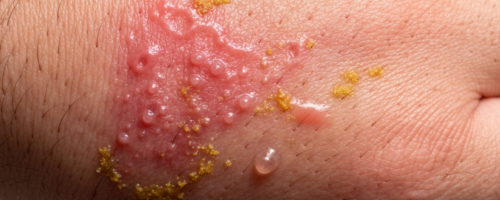 Allergic dermatitis symptoms pictures