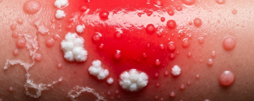 Thrush in men symptoms pictures