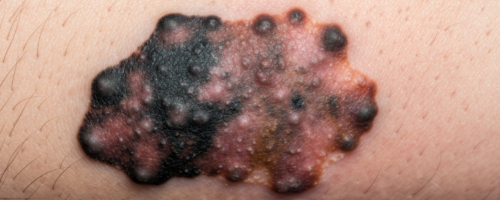 nevus symptoms pictures