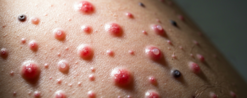 implantation bleeding symptoms pictures