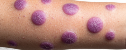 stomatitis in adults symptoms pictures