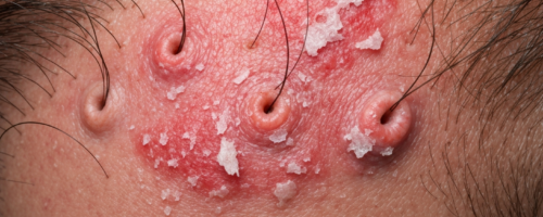 psoriasis on the scalp symptoms pictures