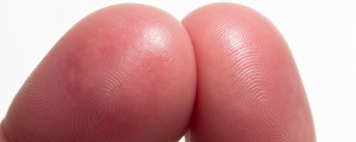 felon symptoms pictures