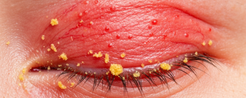 blepharitis symptoms pictures