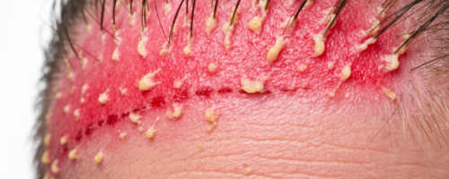 seborrheic dermatitis on the scalp symptoms pictures