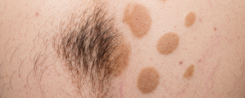 scoliosis symptoms pictures