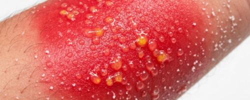 contact dermatitis symptoms pictures