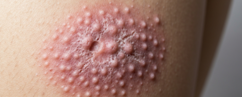 lupus symptoms pictures