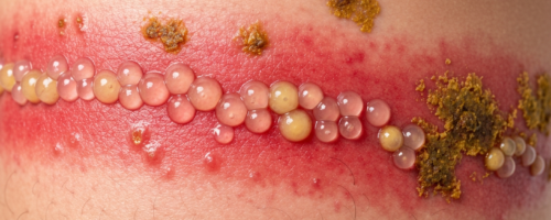 shingles symptoms pictures