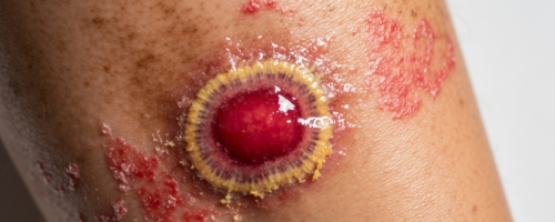 trophic ulcer symptoms pictures