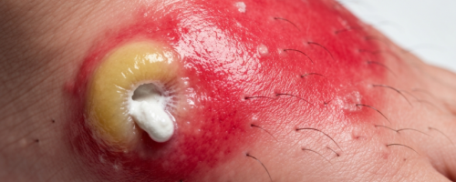 Gout on the legs symptoms pictures