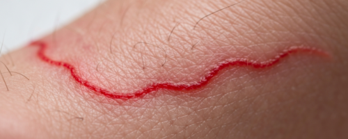 Human worms symptoms pictures