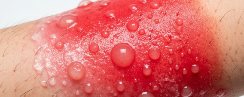 Second-degree burn symptoms pictures