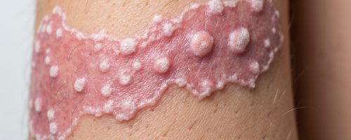 Erythema symptoms pictures