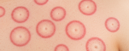 Tuzhilin spots symptoms pictures