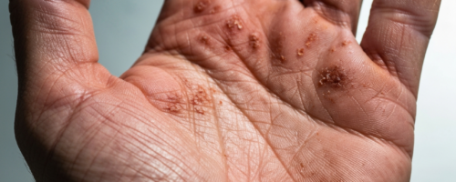 Periodontosis symptoms pictures