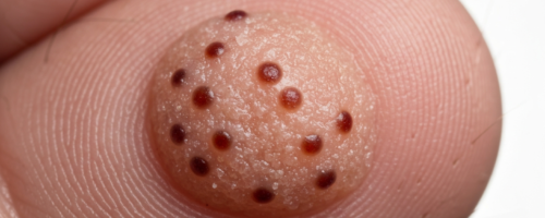 Warts symptoms pictures