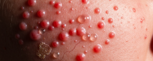 Conjunctivitis symptoms pictures