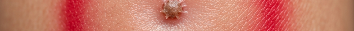 Symptoms and pictures