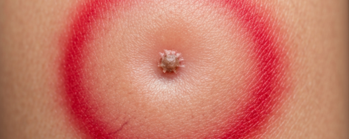 Tick bite symptoms pictures